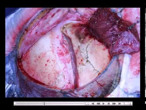 Craniotomia e Cicatrice: Approcci e Considerazioni