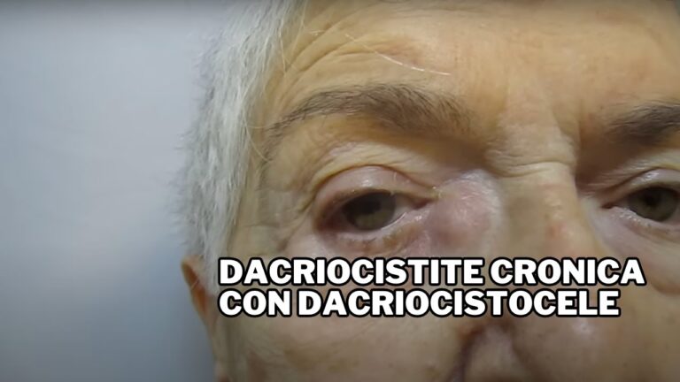 Ghiandola Lacrimale Gonfia: Cause e Rimedi