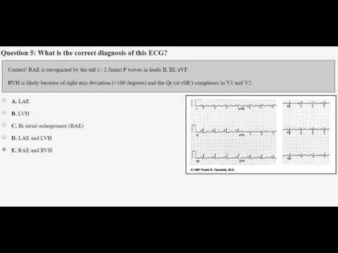 Ipertrofia Ventricolare Sinistra: Interpretazione ECG e Implicazioni Cliniche