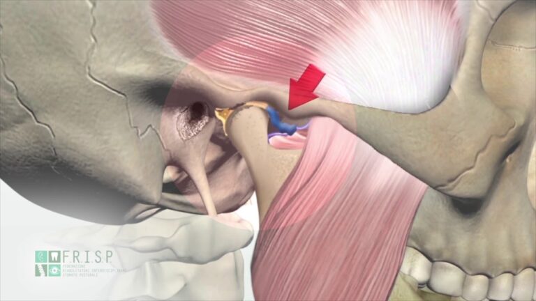 Comprendere il Menisco Mandibolare: Funzioni e Patologie