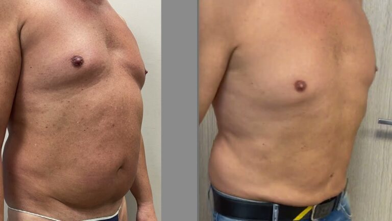 Liposuzione Gratuita: Opportunità e Vantaggi