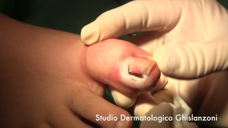 Rimedio Efficace per Unghie Incarnite