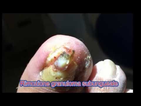 Granuloma alluce: Cause, Sintomi e Trattamenti Efficaci