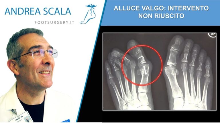 Alluce Valgo: Conseguenze di un Intervento Non Riuscito