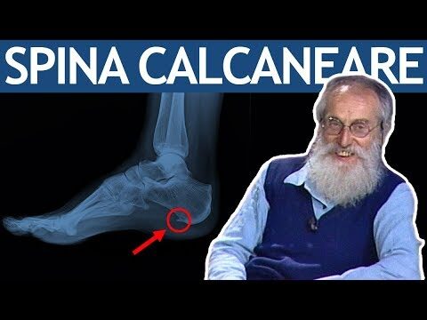 Spina Calcaneare: L’Influenza dell’Alimentazione sulla Salute del Piede