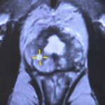 Scoliosi: Rischi e Prevenzione della Malattia