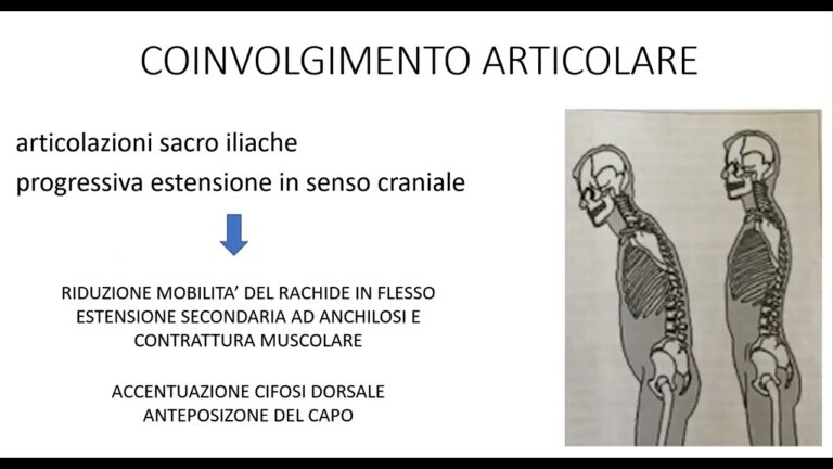Spondilite Anchilosante: Camminare per Migliorare la Qualità della Vita