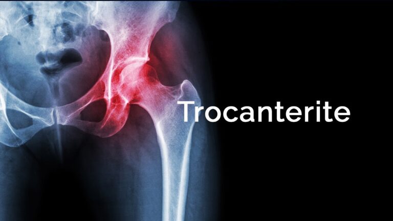 Trocantere: Cos’è e la sua Importanza nell’Anatomia Umana
