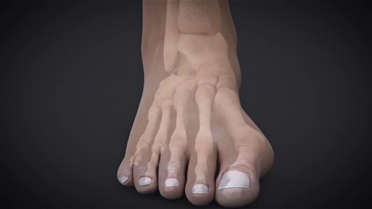 Tecnica Percutanea per Correggere l’Alluce Valgo