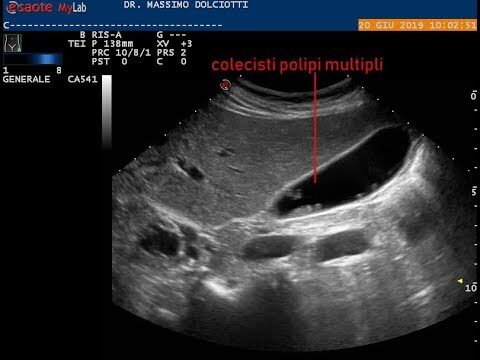 Adenomioma della Colecisti: Approfondimento su Lesioni da 4 a 6 mm