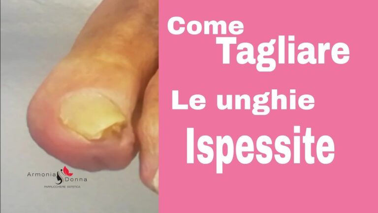 Cause e rimedi per l’ispessimento delle unghie dei piedi