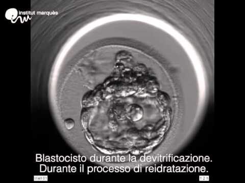 Tempistiche per l’impianto dopo il trasferimento di blastocisti congelate