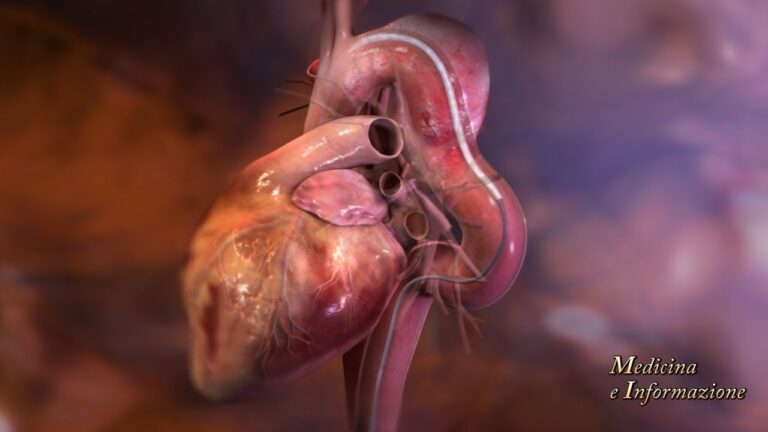 Guida alla Convalescenza Dopo un Intervento per Aneurisma dell’Aorta Addominale
