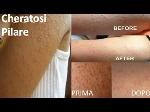 Pelle Granulosa al Tatto: Cause e Soluzioni