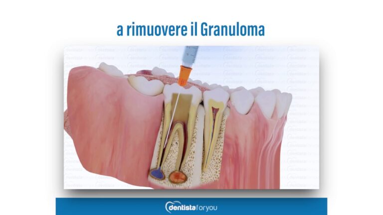 Rischi e Complicazioni: Morire per un Granuloma Dentale?