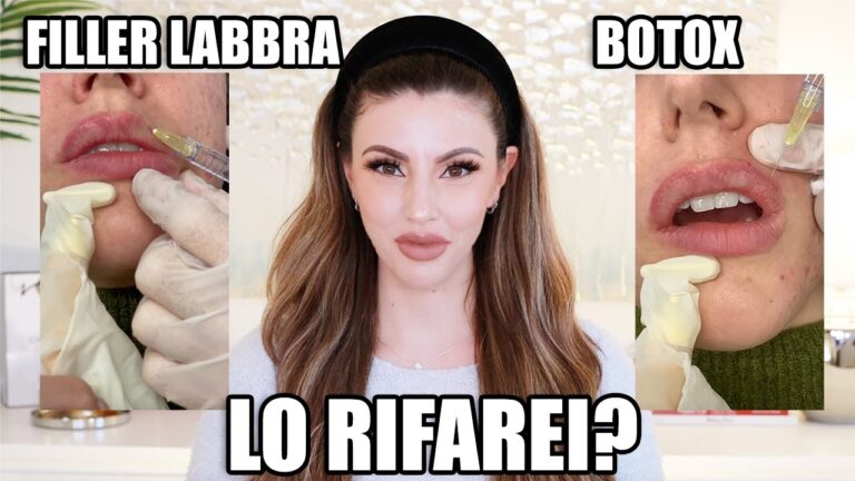 Risultati Botox Labbra: Prima e Dopo