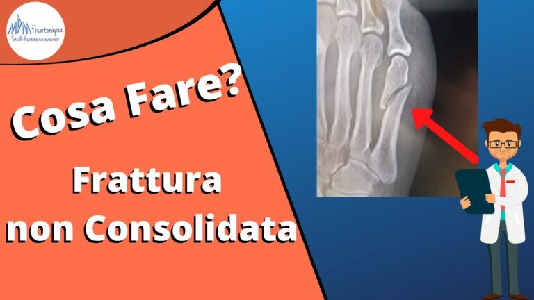 Tempi di Guarigione per Fratture del Dito della Mano