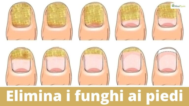 Rimedi Naturali per il Fungo delle Unghie dei Piedi
