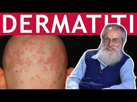 Eczema Nummulare: Cause e Rimedi per la Non Guarigione