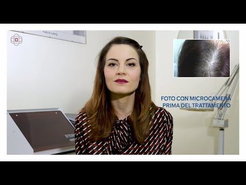 Diradamento Frontale dei Capelli nelle Donne: Cause e Soluzioni