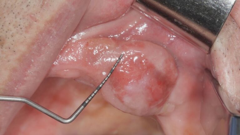 Granuloma di Dente Devitalizzato: Cause e Trattamenti