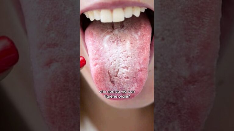 Lingua con Macchie: Cause e Rimedi