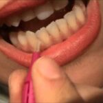 Verruche: scopri l’inaspettato potere della candeggina!