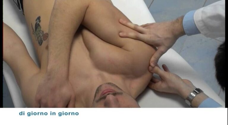 Complicanze della Lussazione Acromion-Claveare Non Curata