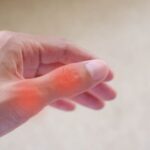Dieta disintossicante per orticaria: una guida completa