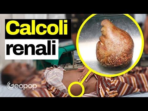 Acqua: Sollievo Naturale per i Calcoli Renali