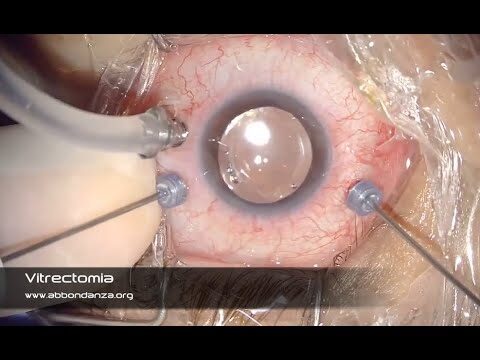 Vitrectomia: Cos’è e Come Funziona