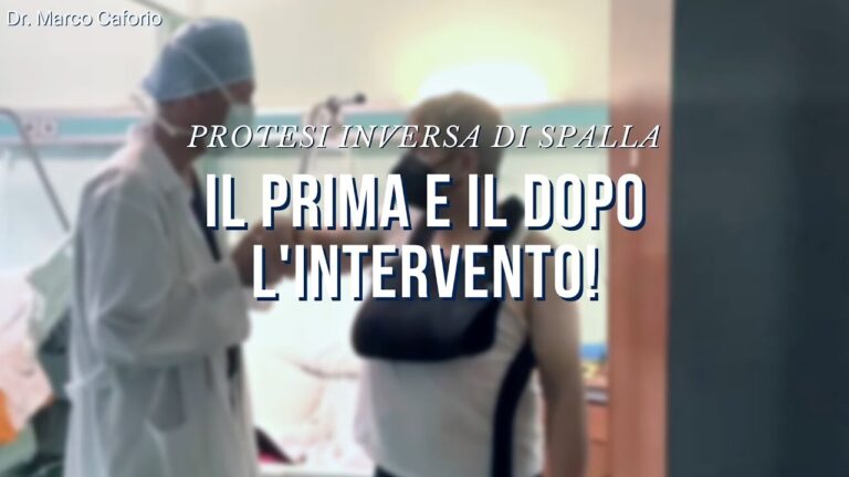 Recupero dopo Protesi Inversa della Spalla: Tempi e Aspettative