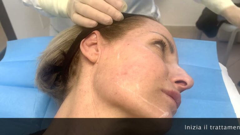 Risultati dei Fili di Trazione per gli Occhi: Prima e Dopo