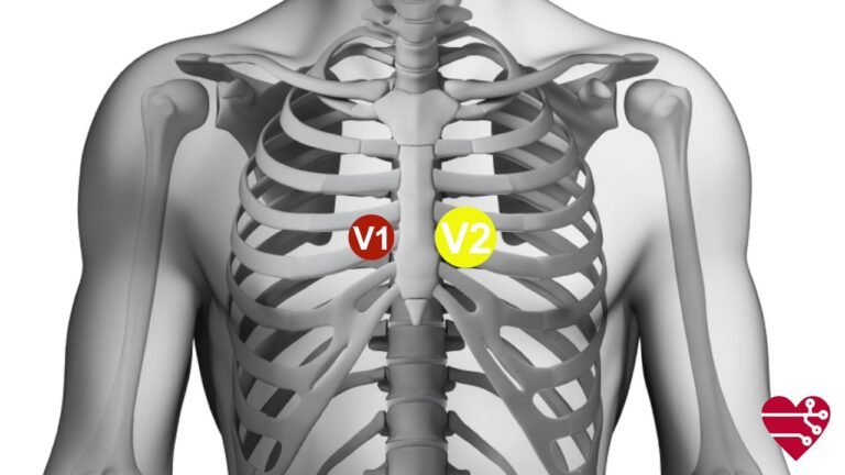 Posizionamento Ottimale degli Elettrodi ECG