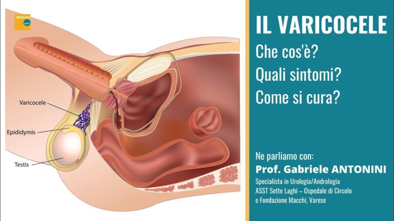 Gradi del Varicocele: Comprendere e Gestire la Patologia