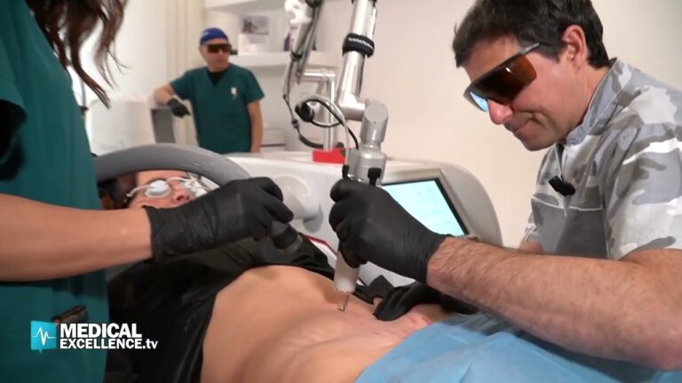 Risultati del Trattamento Laser per Smagliature: Prima e Dopo