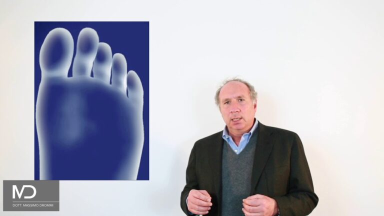 Metatarsalgia Persistente: Cause e Soluzioni Efficaci