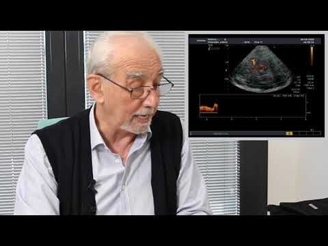 Doppler Transcranico Positivo: Vantaggi e Applicazioni Cliniche