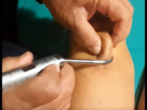 Cicatrici e Protesi al Ginocchio: Guida alla Recupero Ottimale