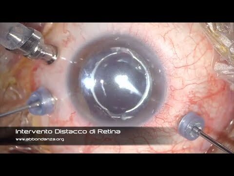 Intervento per Distacco della Retina: Guida e Opzioni terapeutiche