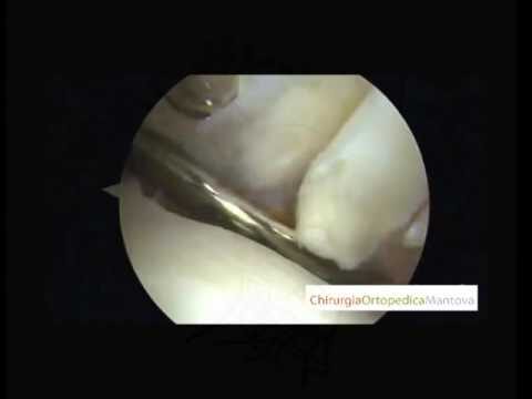 Tenotomia CLB: Tecniche e Benefici