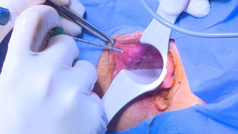 Intervento Laser per Emorroidi: Vantaggi e Procedure