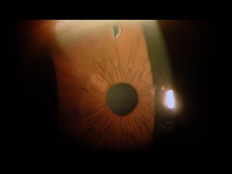 Recensioni sull’Iridotomia con Laser YAG