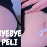 Intervento cistocele: Scopri le Ultime Novit&agrave;