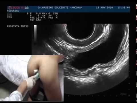 Ecografia Transrettale: Un’Analisi Essenziale per la Salute Prostatica