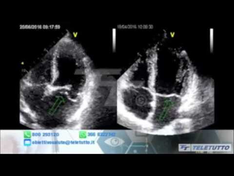 Funzione e Patologie della Valvola Mitralica del Cuore