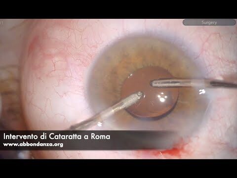 I migliori centri per intervento di cataratta a Roma