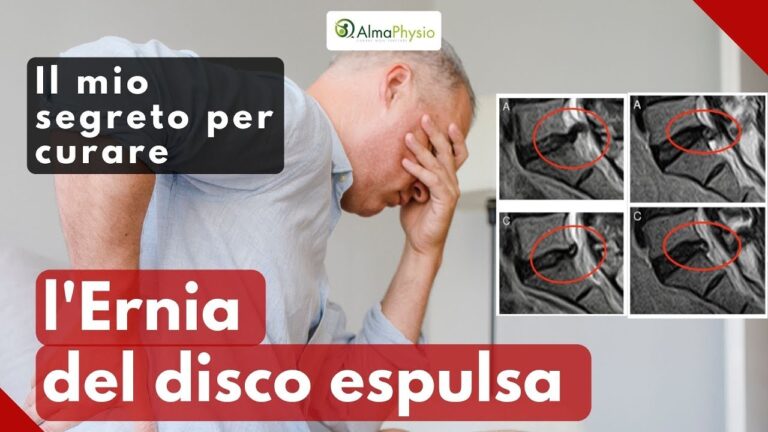 Esercizi e Rimedi per l’Eernia Espulsa: Cosa Fare