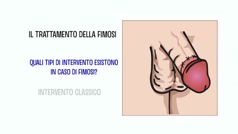 Intervento Chirurgico per la Fimosi: Guida Pratica