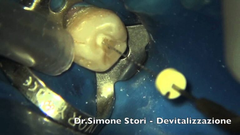 Durata del Dolore Dopo la Devitalizzazione del Dente